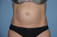 Tummy Tuck Before & After Gallery - Patient 25279781 - Image 1