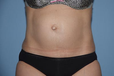Tummy Tuck Before & After Gallery - Patient 25279781 - Image 1