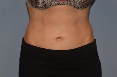 Tummy Tuck Before & After Gallery - Patient 25279781 - Image 2