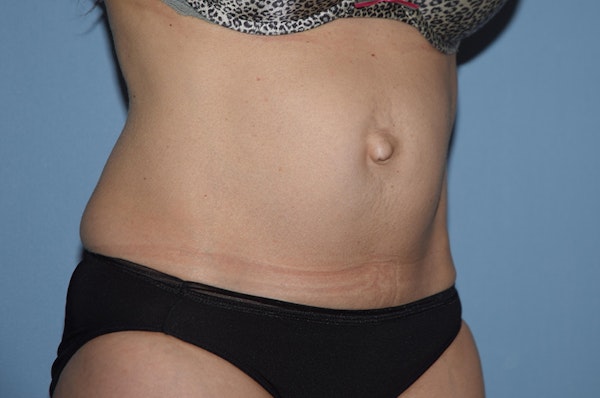 Tummy Tuck Before & After Gallery - Patient 25279781 - Image 3