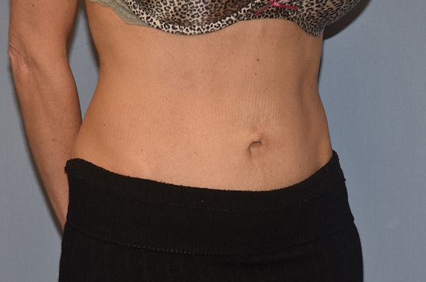 Tummy Tuck Before & After Gallery - Patient 25279781 - Image 4