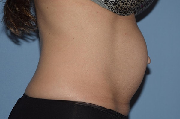 Tummy Tuck Before & After Gallery - Patient 25279781 - Image 5