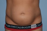 Tummy Tuck Before & After Gallery - Patient 25279989 - Image 1