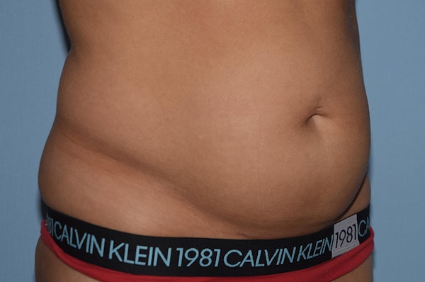 Tummy Tuck Before & After Gallery - Patient 25279989 - Image 3