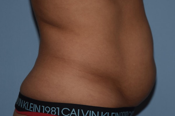 Tummy Tuck Before & After Gallery - Patient 25279989 - Image 5