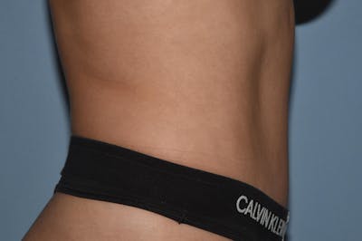 Tummy Tuck Before & After Gallery - Patient 25279989 - Image 6