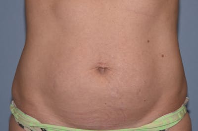 Tummy Tuck Before & After Gallery - Patient 25280247 - Image 1