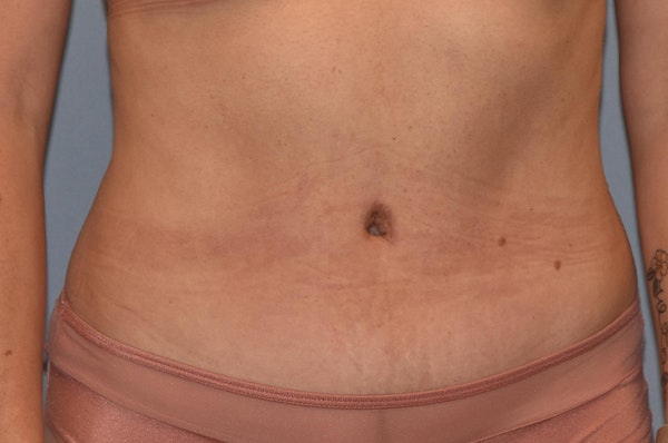Tummy Tuck Before & After Gallery - Patient 25280247 - Image 2