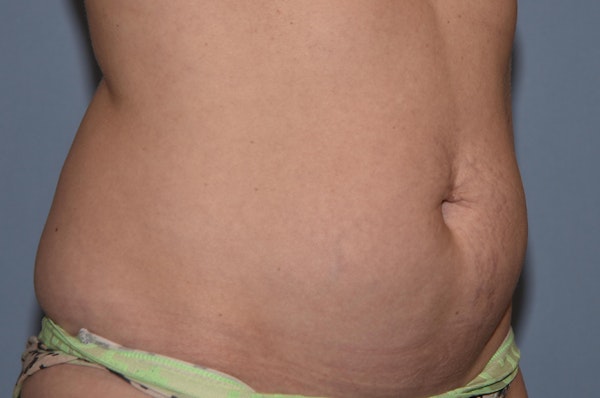 Tummy Tuck Before & After Gallery - Patient 25280247 - Image 3