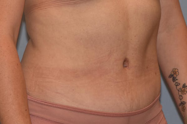 Tummy Tuck Gallery - Patient 25280247 - Image 4