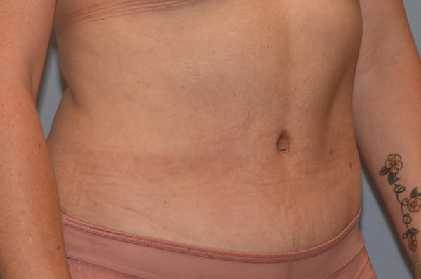 Tummy Tuck Before & After Gallery - Patient 25280247 - Image 4