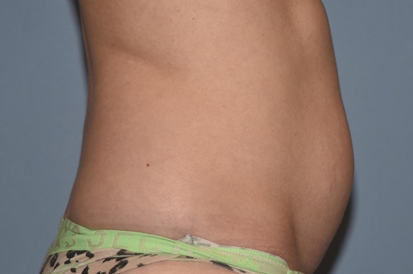 Tummy Tuck Before & After Gallery - Patient 25280247 - Image 5