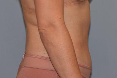 Tummy Tuck Gallery - Patient 25280247 - Image 6