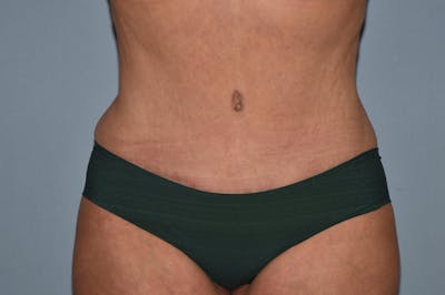 Tummy Tuck Before & After Gallery - Patient 25280270 - Image 2