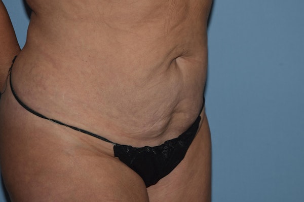 Tummy Tuck Before & After Gallery - Patient 25280270 - Image 3