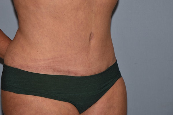 Tummy Tuck Before & After Gallery - Patient 25280270 - Image 4