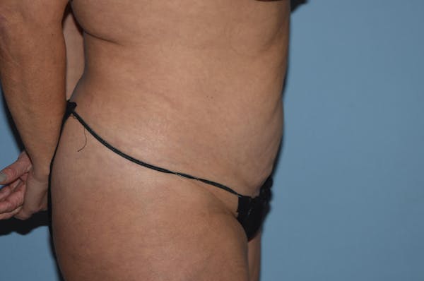 Tummy Tuck Before & After Gallery - Patient 25280270 - Image 5