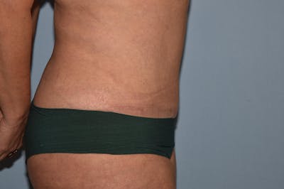 Tummy Tuck Before & After Gallery - Patient 25280270 - Image 6