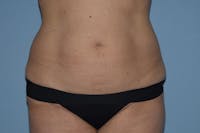 Tummy Tuck Before & After Gallery - Patient 25280440 - Image 1
