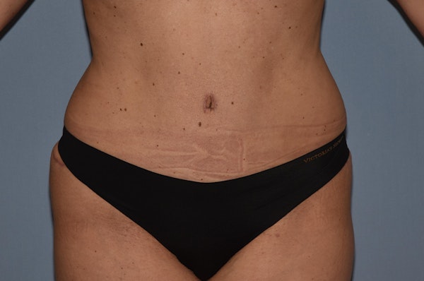 Tummy Tuck Before & After Gallery - Patient 25280440 - Image 2
