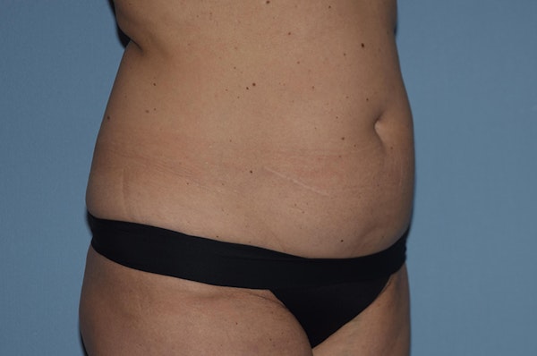 Tummy Tuck Before & After Gallery - Patient 25280440 - Image 3
