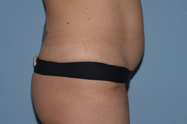 Tummy Tuck Before & After Gallery - Patient 25280440 - Image 5