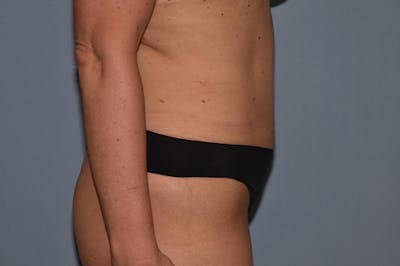 Tummy Tuck Before & After Gallery - Patient 25280440 - Image 6
