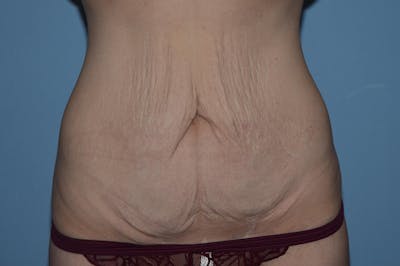Tummy Tuck Before & After Gallery - Patient 25280456 - Image 1