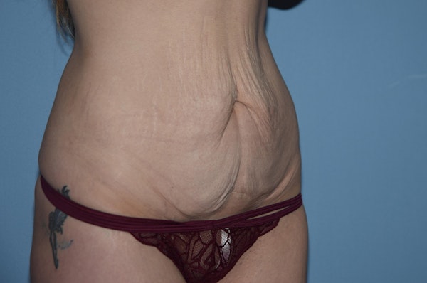 Tummy Tuck Before & After Gallery - Patient 25280456 - Image 3