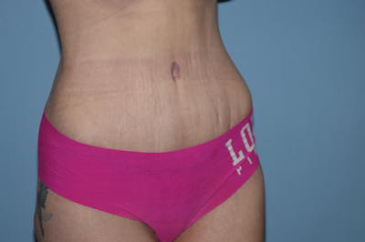 Tummy Tuck Before & After Gallery - Patient 25280456 - Image 4