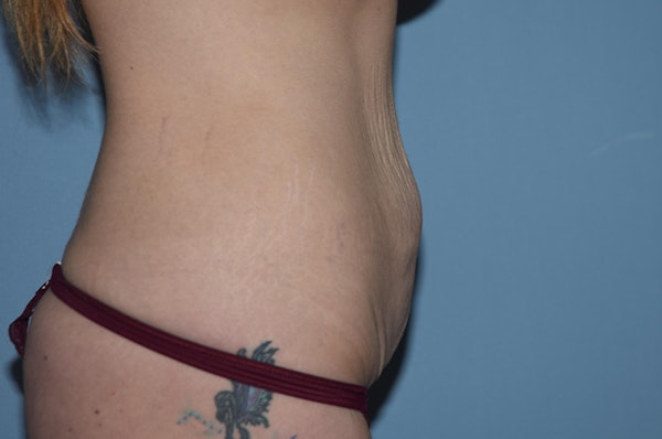 Tummy Tuck Before & After Gallery - Patient 25280456 - Image 5