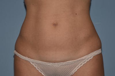 Tummy Tuck Before & After Gallery - Patient 25280479 - Image 1