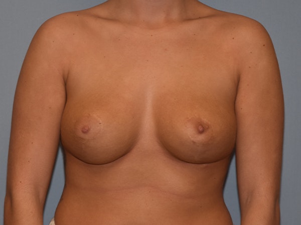 Breast Reduction Before & After Gallery - Patient 25992998 - Image 2
