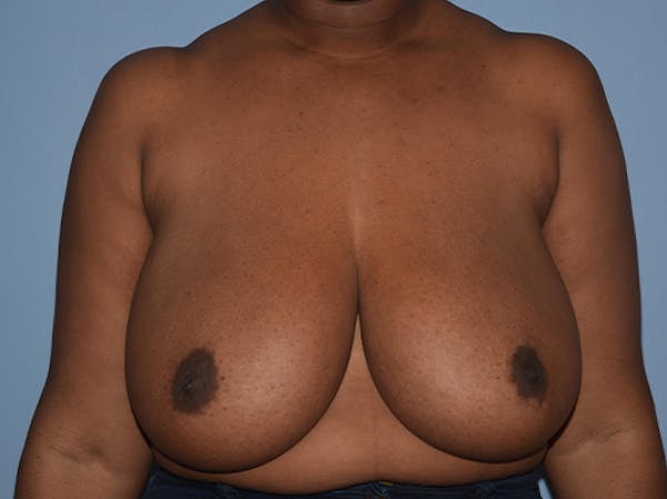 Breast Reduction Gallery - Patient 25993027 - Image 1