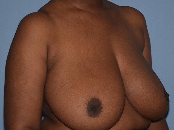 Breast Reduction Before & After Gallery - Patient 25993027 - Image 3