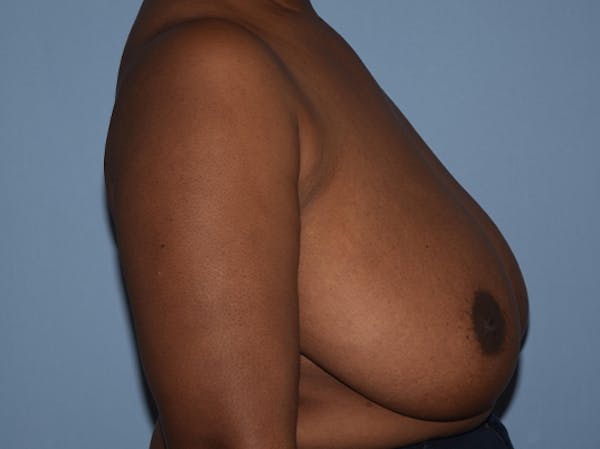 Breast Reduction Gallery - Patient 25993027 - Image 5