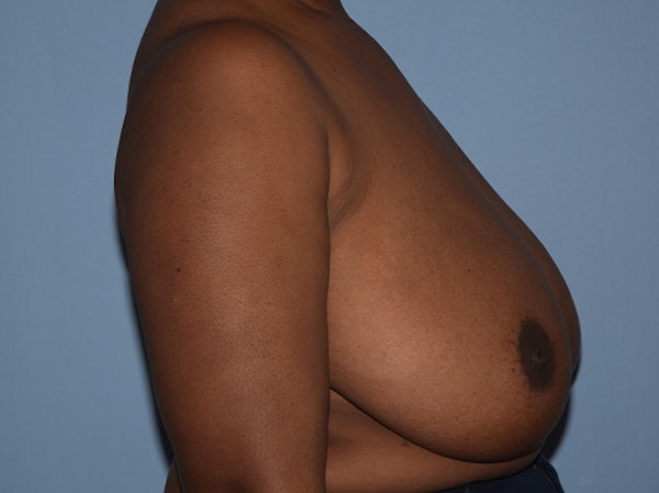 Breast Reduction Before & After Gallery - Patient 25993027 - Image 5