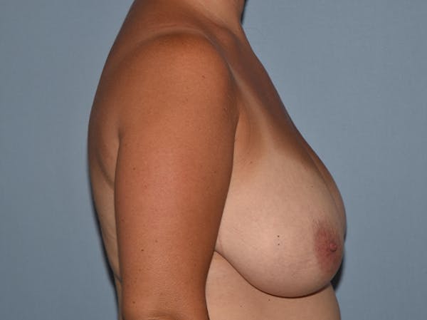 Breast Reduction Gallery - Patient 25993238 - Image 3