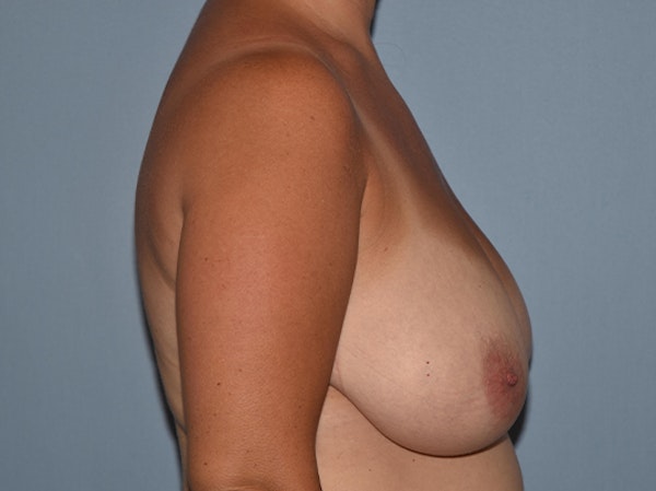 Breast Reduction Before & After Gallery - Patient 25993238 - Image 3