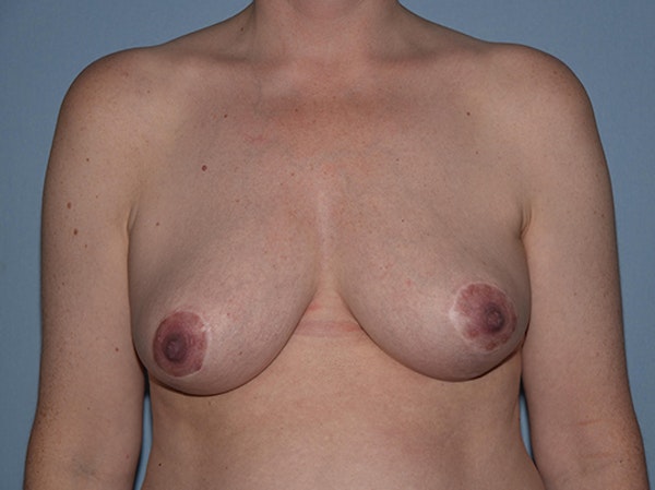 Breast Reduction Before & After Gallery - Patient 25993656 - Image 2