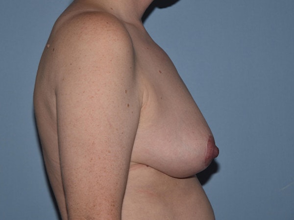 Breast Reduction Before & After Gallery - Patient 25993656 - Image 4