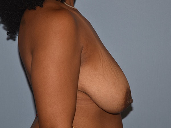 Breast Reduction Before & After Gallery - Patient 25993777 - Image 3