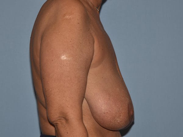 Breast Reduction Gallery - Patient 25994861 - Image 3
