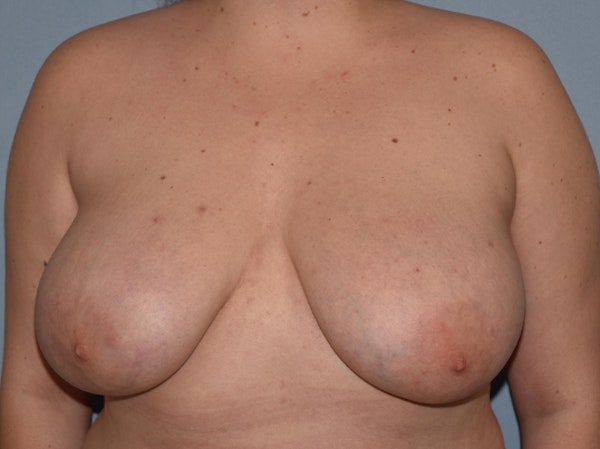 Breast Reduction Before & After Gallery - Patient 25994949 - Image 1