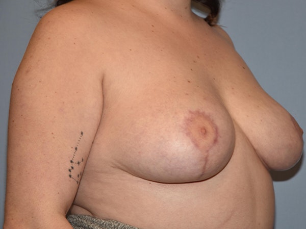 Breast Reduction Before & After Gallery - Patient 25994949 - Image 4