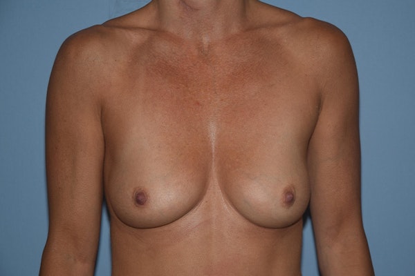 Breast Augmentation  Before & After Gallery - Patient 29752435 - Image 1