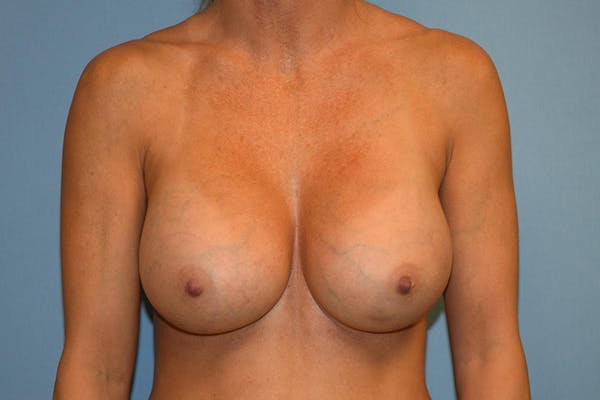 Breast Augmentation  Before & After Gallery - Patient 29752435 - Image 2