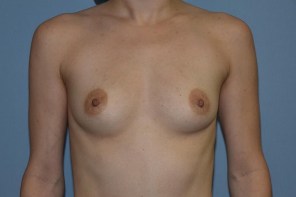 Breast Augmentation  Before & After Gallery - Patient 29764503 - Image 1