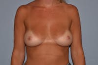 Breast Augmentation  Gallery - Patient 30277225 - Image 1