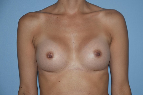 Breast Augmentation  Before & After Gallery - Patient 30277894 - Image 2